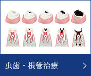 虫歯治療・根管治療