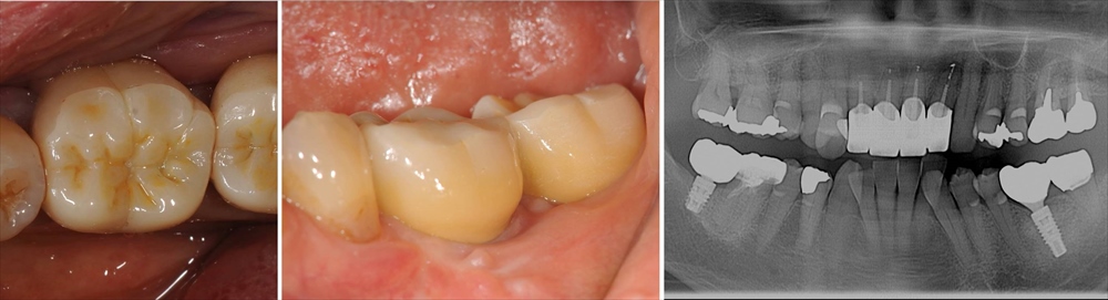 インプラント治療後