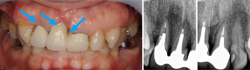 歯肉退縮とセラミッククラウン