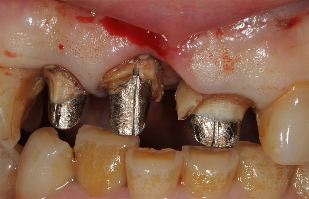補綴物除去後の支台歯の状態