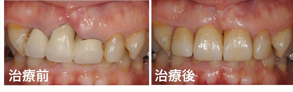 歯ぐきが下がった治療