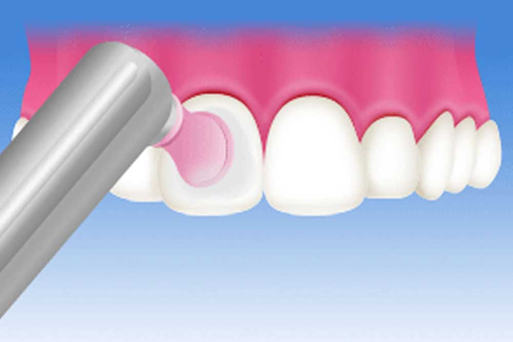 歯の定期クリーニング