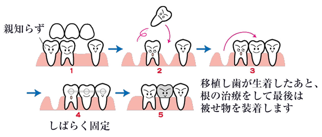 痛くない親知らずの抜歯 移植 親知らずは抜かない 東小金井歯科